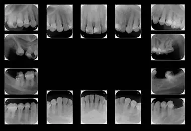 Radiografía seriada periapical AB Imágenes Dentales